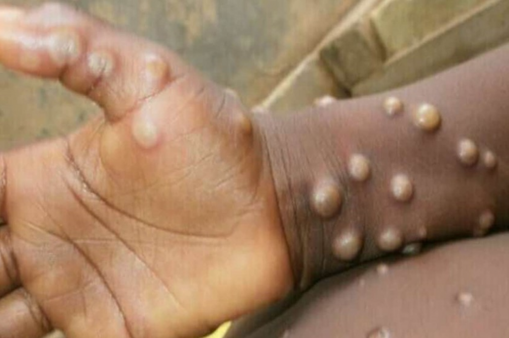Monkeypox A New Disease Outbreak-content-shipdiary.com